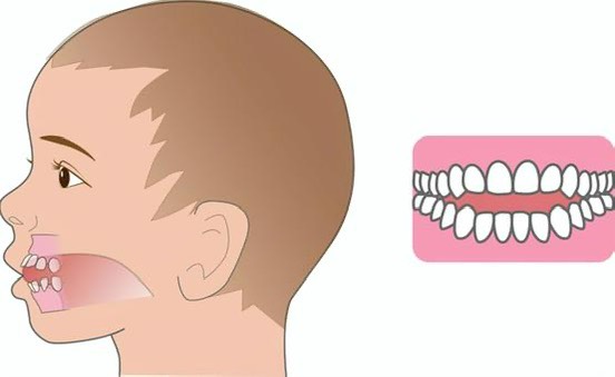 舌の位置で歯並びが変わる？
