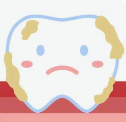 プラークと歯石の違いって？🦷✨
